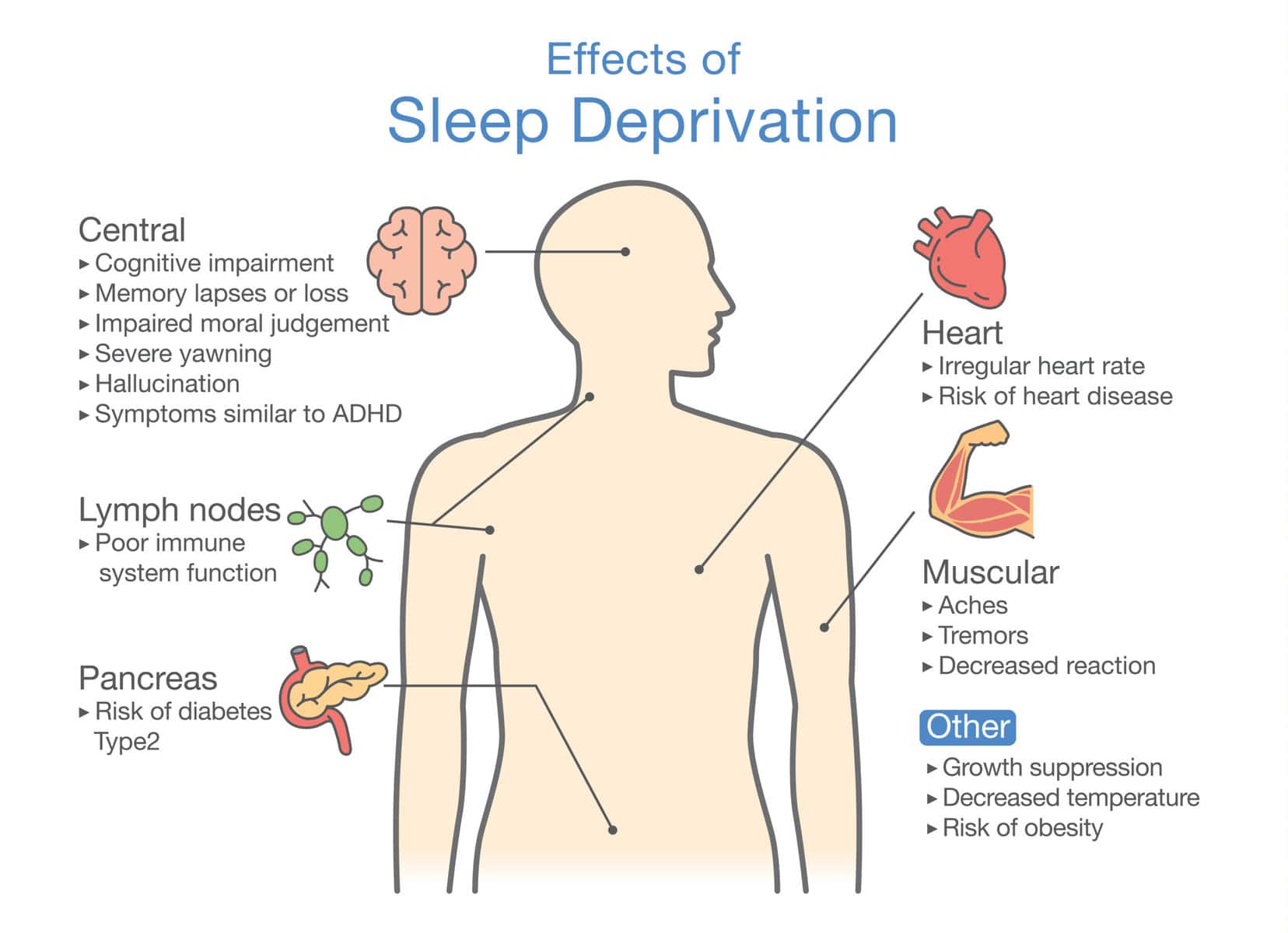 Diagram of Effects of Sleep deprivation.