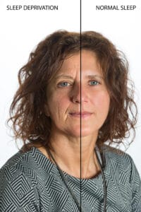 Effects of sleep deprivation on a woman's face, comparison before and after sleep deprivation and normal rest