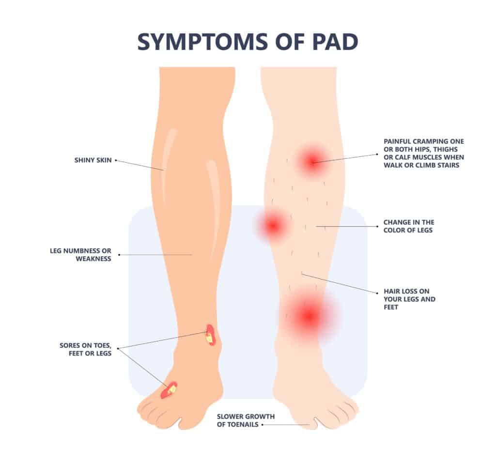 symptoms of PAD